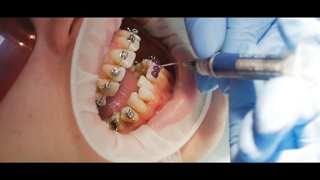 Фиксация брекет системы смотреть онлайн