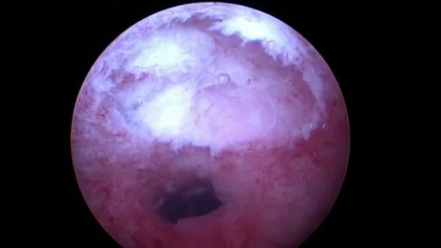 2.5 cm G1 Cervical Myoma смотреть онлайн