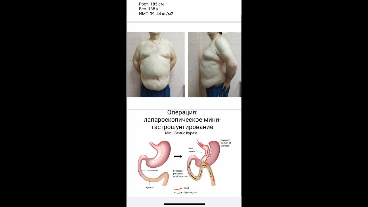 Ожирение. Как помочь пациенту с таким диагнозом?