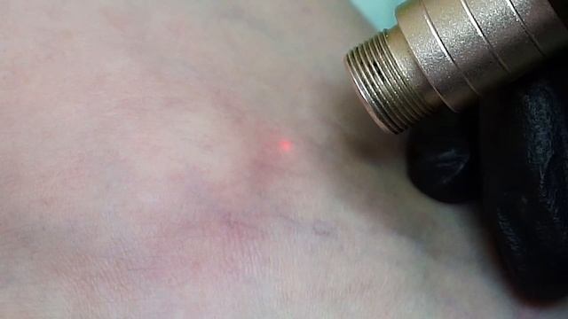 Удаление Сосудистых Звёздочек На Ногах смотреть онлайн