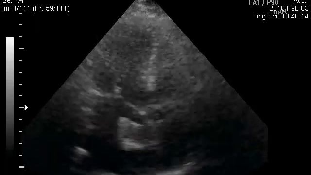 тромб левого предсердия имитирующий миксому