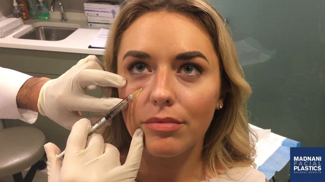 Tear trough fillers with Belotero смотреть онлайн