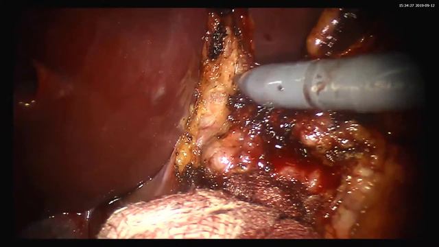 Robotic subtotal gastrectomy. Роботическая дистальная субтотальная резекция желудка. смотреть онлайн
