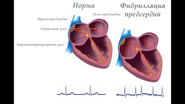 Симптомы аритмии сердца смотреть онлайн