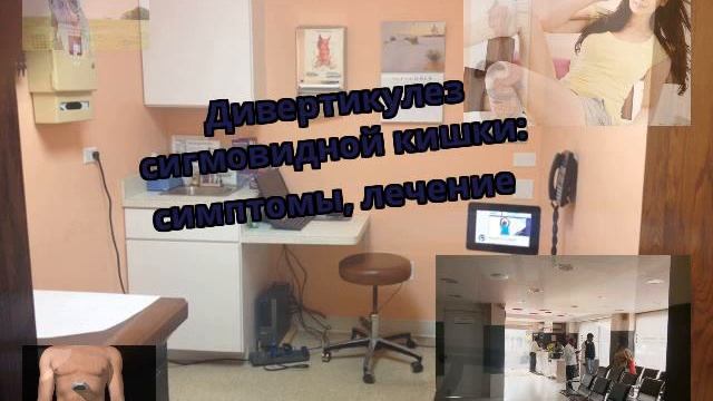 Дивертикулез сигмовидной кишки: симптомы, лечение смотреть онлайн