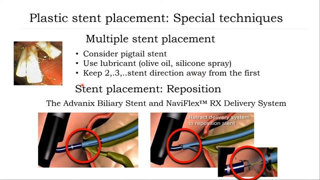 ERCP Series 5 Stricture Management English Version FC смотреть онлайн