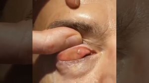 Удаление ячменя (халязиона)