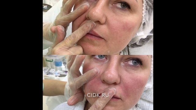 Устранение носогубных складок в ЦИДК смотреть онлайн