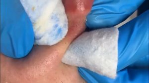 Давим Чёрные Точки и Червяки На Носу!