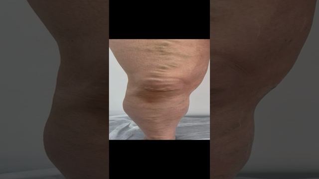 Варикоз по всей ноге. Готовимся к операции. Флеболог Москва смотреть онлайн