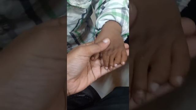 Partial simple syndactyly смотреть онлайн
