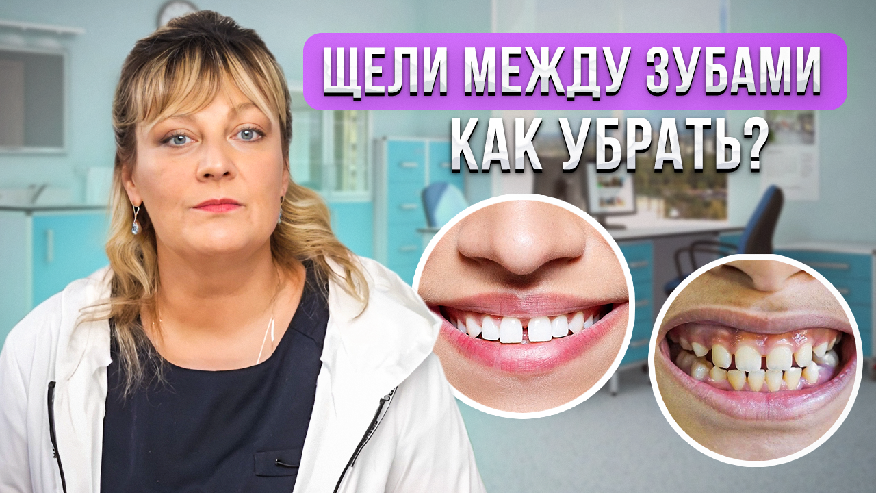 Чем опасны щели между зубами | Как безопасно убрать | Почему после лечения щели появляются вновь