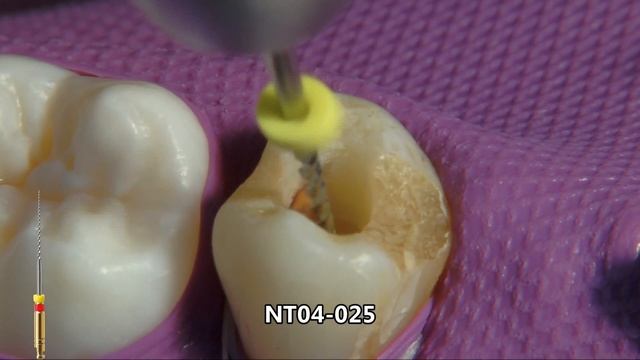 Препарирование Зуба и обработка корневого канала с помощью инструмента NTI смотреть онлайн