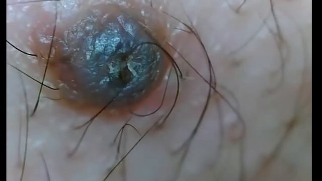 Вросший волос. Слабонервным не смотреть. смотреть онлайн