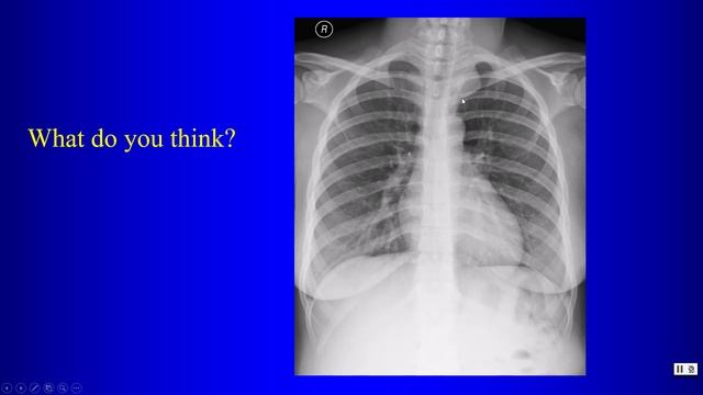 20b Middle and Posterior Mediastinum смотреть онлайн