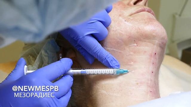 Мезорадиес: процесс