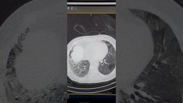 КТ вирусная пневмония с поражением 90% легких