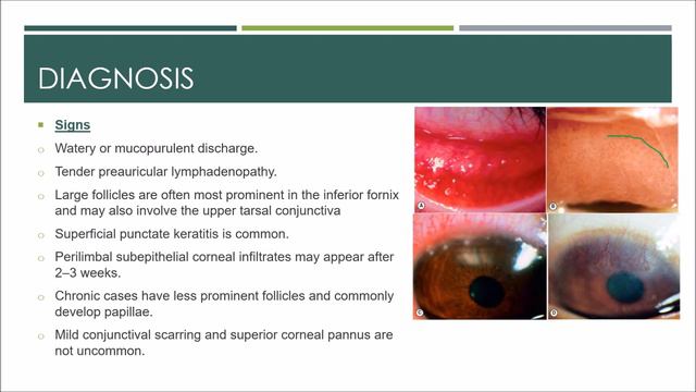 Adult Chlamydial Conjunctivitis #kanskiseries #2022