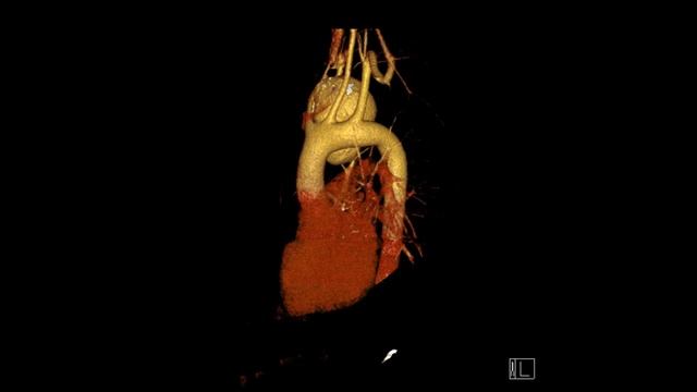 Гигантская ложная аневризма дуги аорты смотреть онлайн