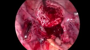 Большая миома матки