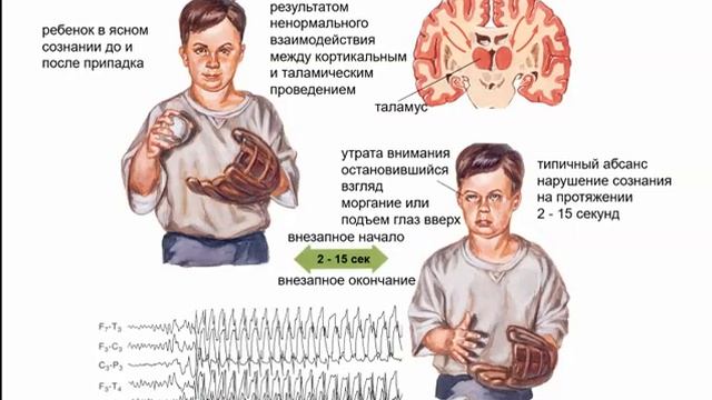 13. Эпилепсия / epilepsy / الصرع смотреть онлайн