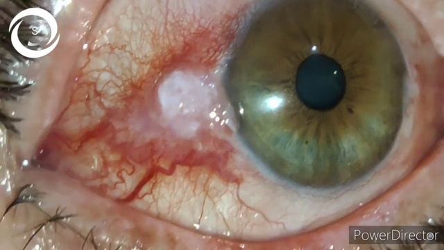 how to prepare interferon alpha 2b for OSSN смотреть онлайн