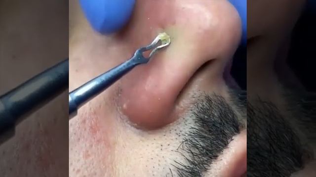 удаление черных точек  №47