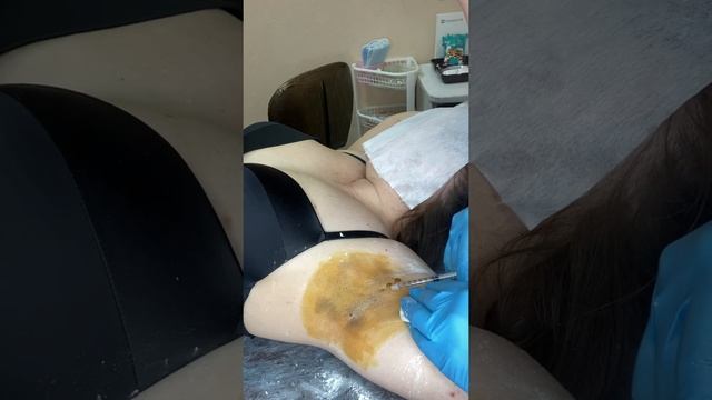 Лечение гипергидроза БТА