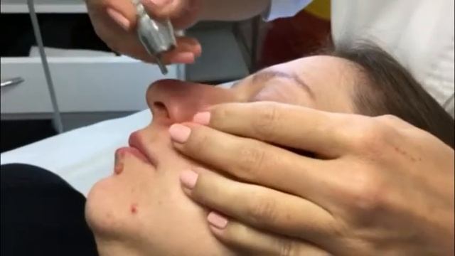 лазерное удаление сосудистой сетки Velure S5 смотреть онлайн