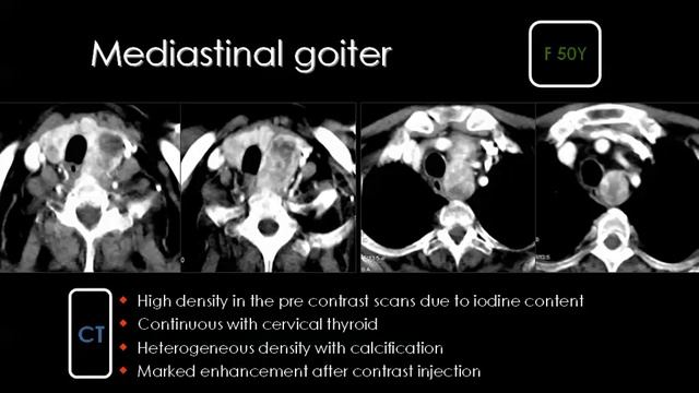 Imaging of Mediastinal lesions - Prof Dr. Mamdouh Mahfouz (In Arabic) смотреть онлайн
