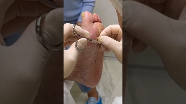 Удаление стержневых мозолей смотреть онлайн