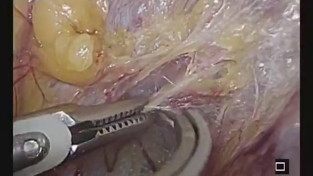 Laparoscopic Lateral Pelvic Wall Anatomy смотреть онлайн