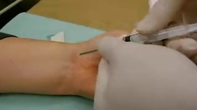 Пункция гигромы (ганглия) смотреть онлайн