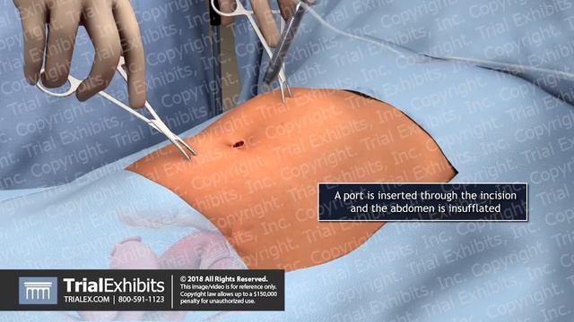 Patient Preparation for Laparoscopic Hysterectomy смотреть онлайн