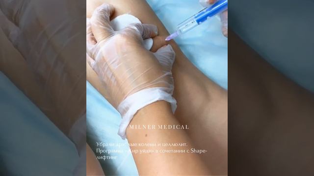 Дряблые колени смотреть онлайн