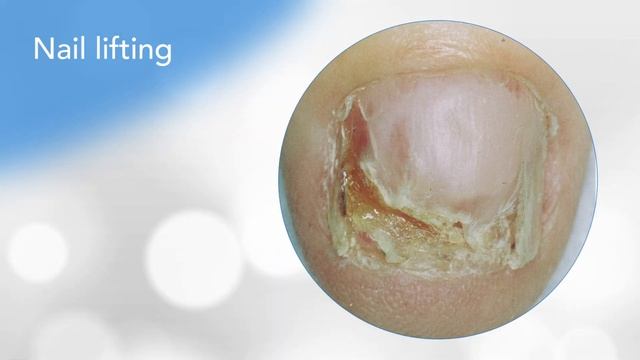 How to check your nails for melanoma смотреть онлайн
