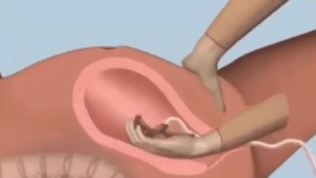 Ручное отделение плаценты. смотреть онлайн