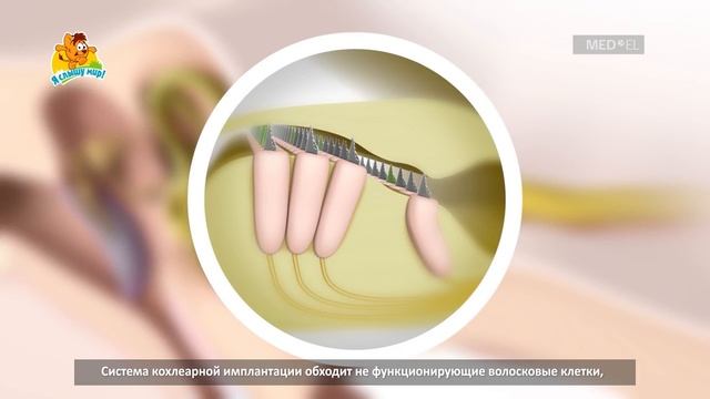 Как работает система кохлеарной имплантации_ (субтитры).mp4 смотреть онлайн
