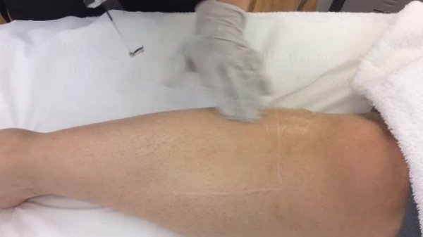 Laser Hair Removal On Legs