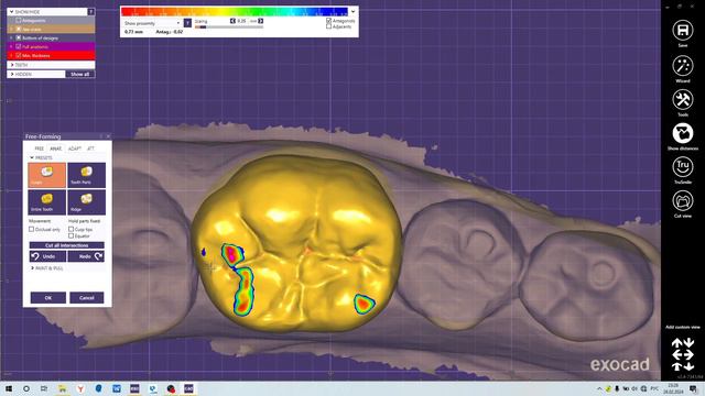 База по Exocad: Моделирование зуба на культе смотреть онлайн