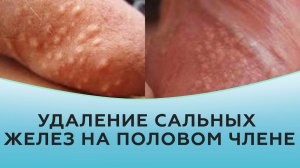 Удаление сальных желез (гранул Фордайса) на половом члене