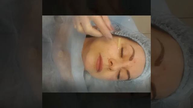 Нитевой лифтинг