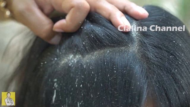 Hair Combing Dandruff / Cialina Channel 1140