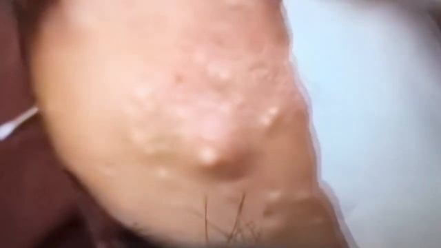 Acne mature!!! Огромные прыщи на голове у девушки!!!! смотреть онлайн