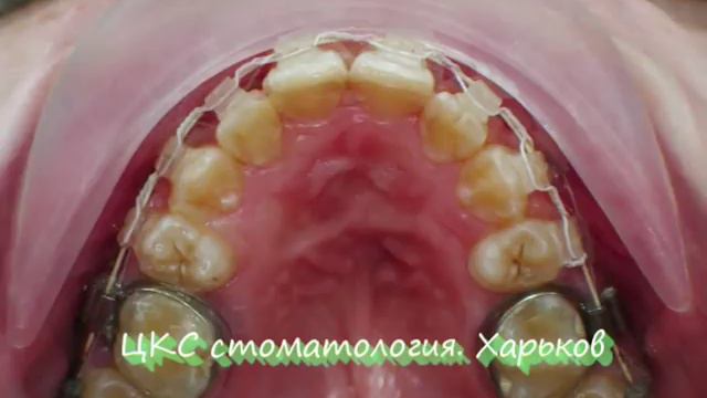 Быстрые брекеты с удалением смотреть онлайн