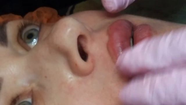 ГУБЫ(т-ф). Верхняя-,,развернуть и поднять,,-заход с линии смыкания смотреть онлайн