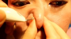 Выдавливание белых точек на носу ложкой уно | Squeezing white dots on the nose with a spoon uno