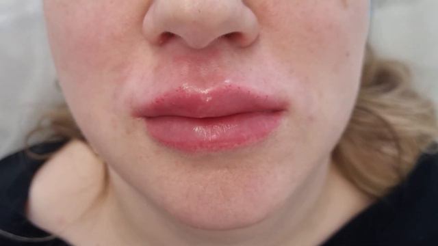 губы после коррекции смотреть онлайн