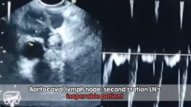 Linear EUS: Aortocaval LN’s смотреть онлайн