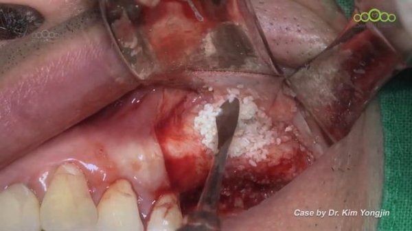 [MULTI_CC] Sinus BG & Implant placement after sinus membrane perforation repair - [Dr. Kim Yongjin]